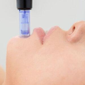 Microneedling Training