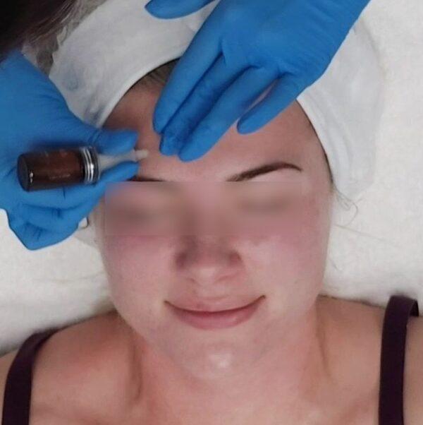 Bio Microneedling Training